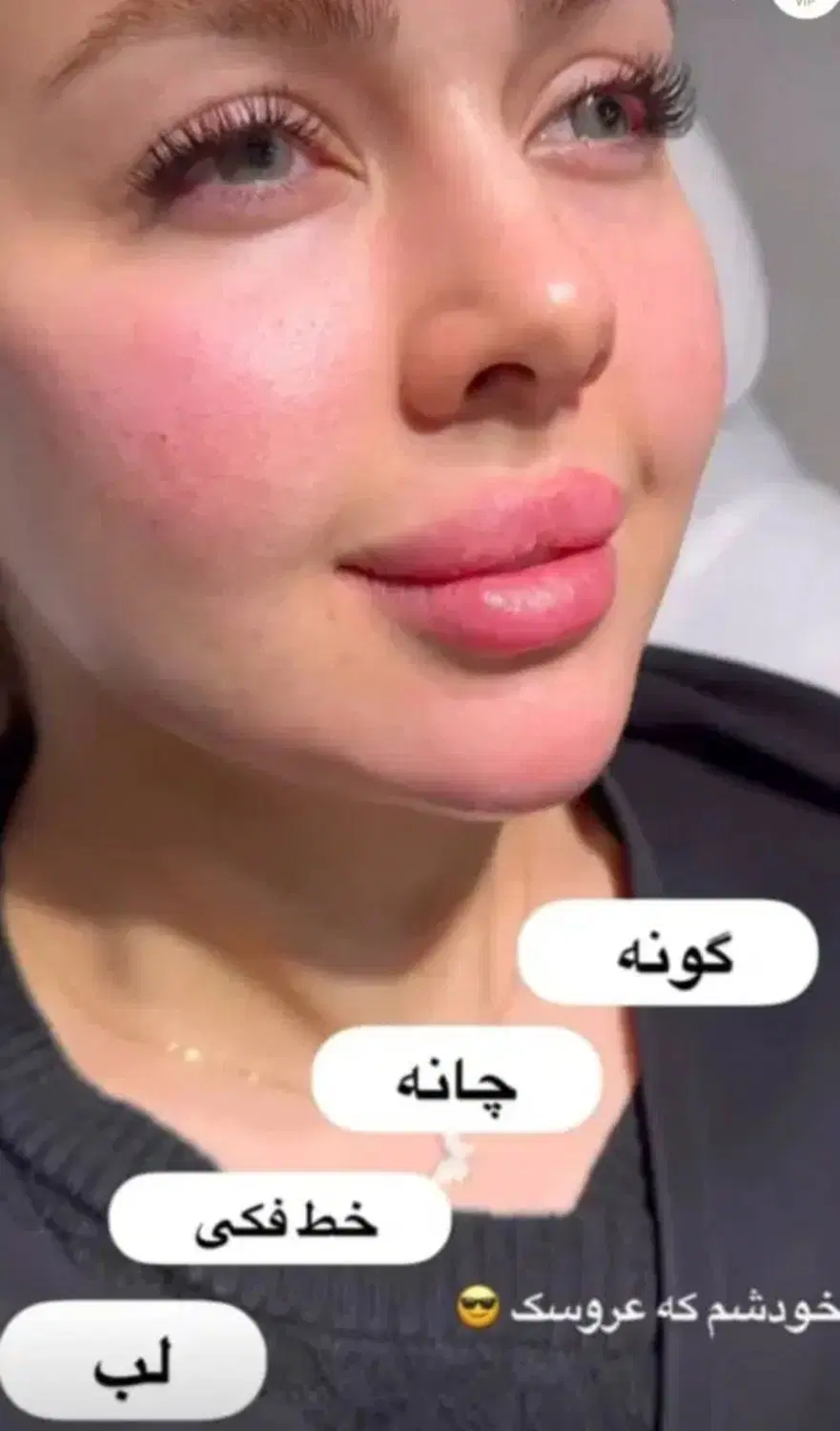 ژل،فیلربادی،بیکینی،بوتاکسprp لیفت صورت|خدمات زیبایی و سلامت|تبریز, |دیوار