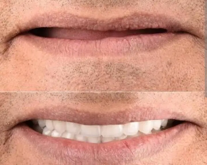 دندان مصنوعی متحرک|خدمات زیبایی و سلامت|تهران, قیطریه|دیوار