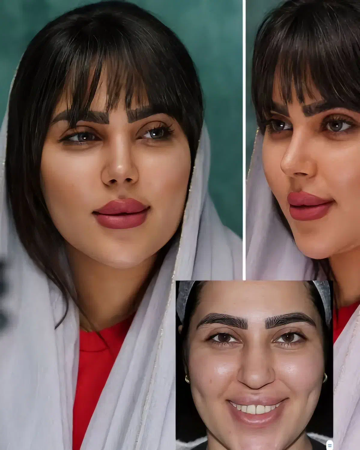 عمل جراحی بینی لیفت خدمات زیبایی با متد پیشرفته|خدمات آرایشگری و زیبایی|کرج, گلشهر|دیوار