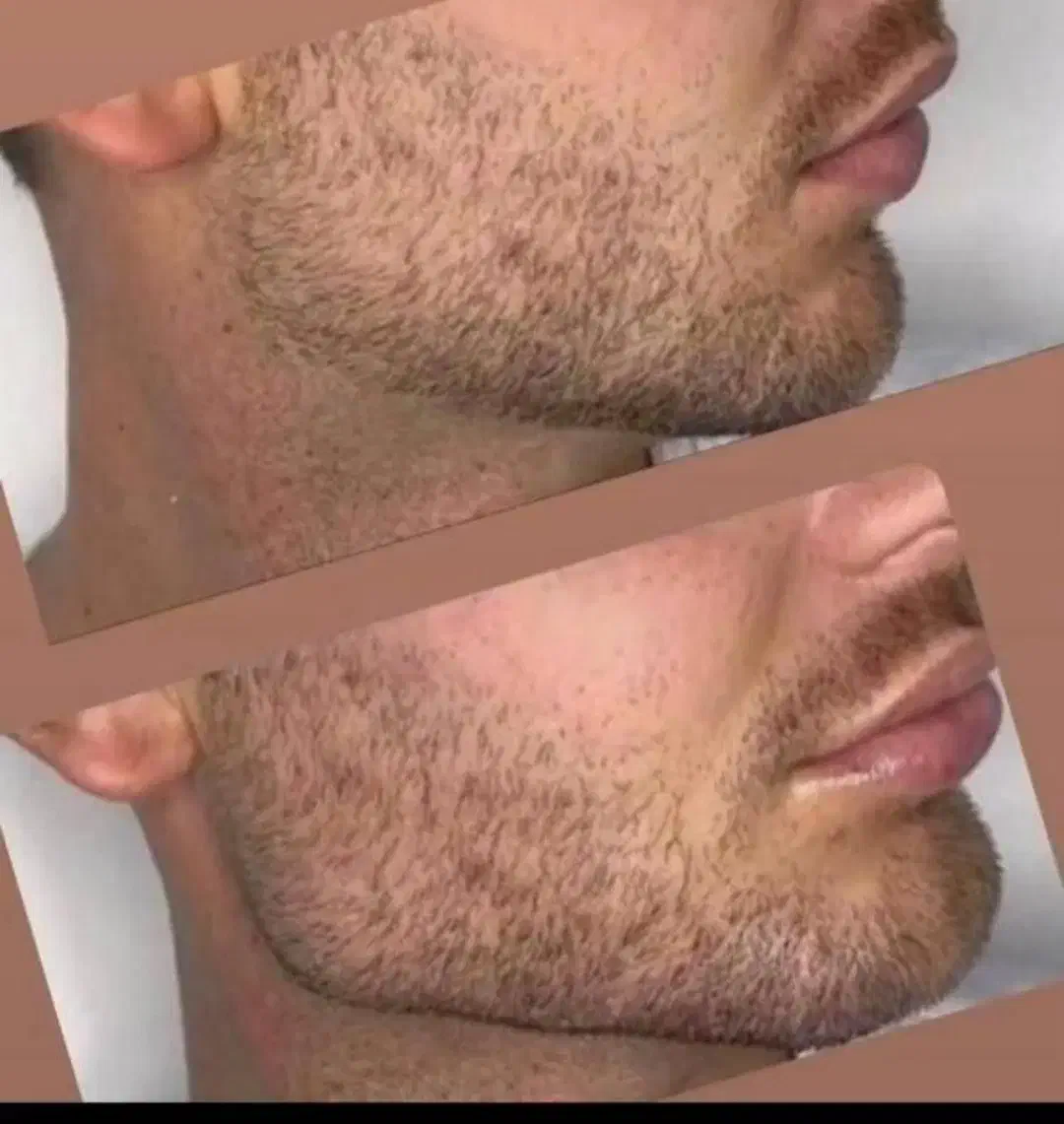 جشنواره ژل بوتاکس فیلر لیزرجوانسازمزو|خدمات آرایشگری و زیبایی|تبریز, |دیوار