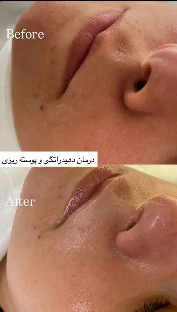 فشیال تخصصی واصلاح تخصصی درماپلینگ|خدمات آرایشگری و زیبایی|بیرجند, |دیوار