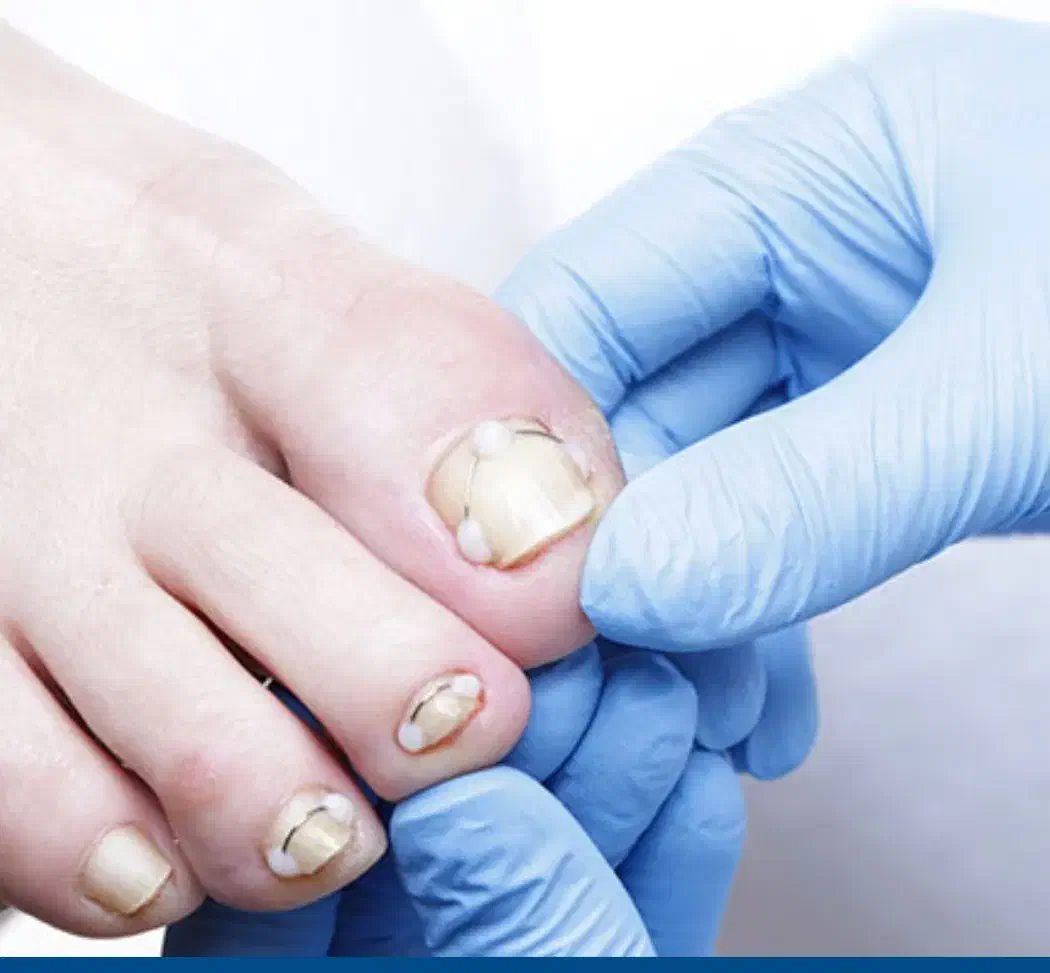 درمان بیماری ناخن ساختمان پزشکان رز پیروزی ۳۸|خدمات آرایشگری و زیبایی|مشهد, چهارچشمه|دیوار