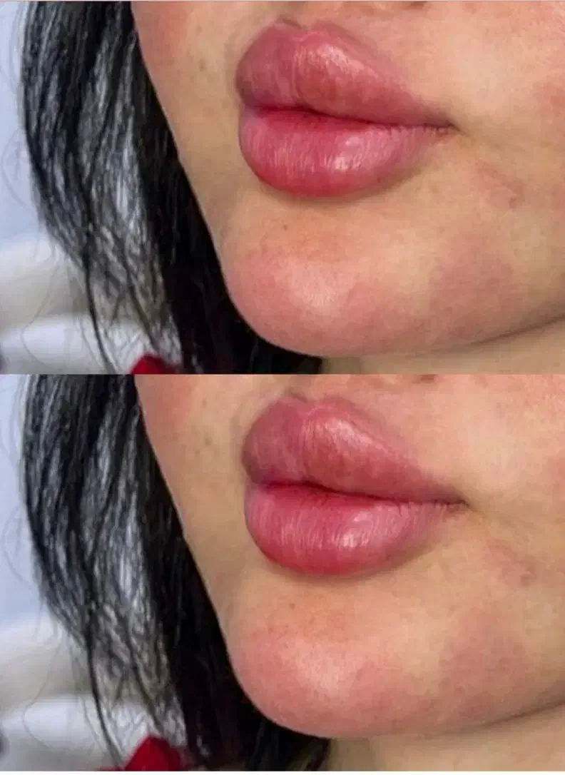 تزریق ژل بوتاکس فیلر لیزرجوانساز مزو مطب زیبایی|خدمات آرایشگری و زیبایی|تبریز, |دیوار