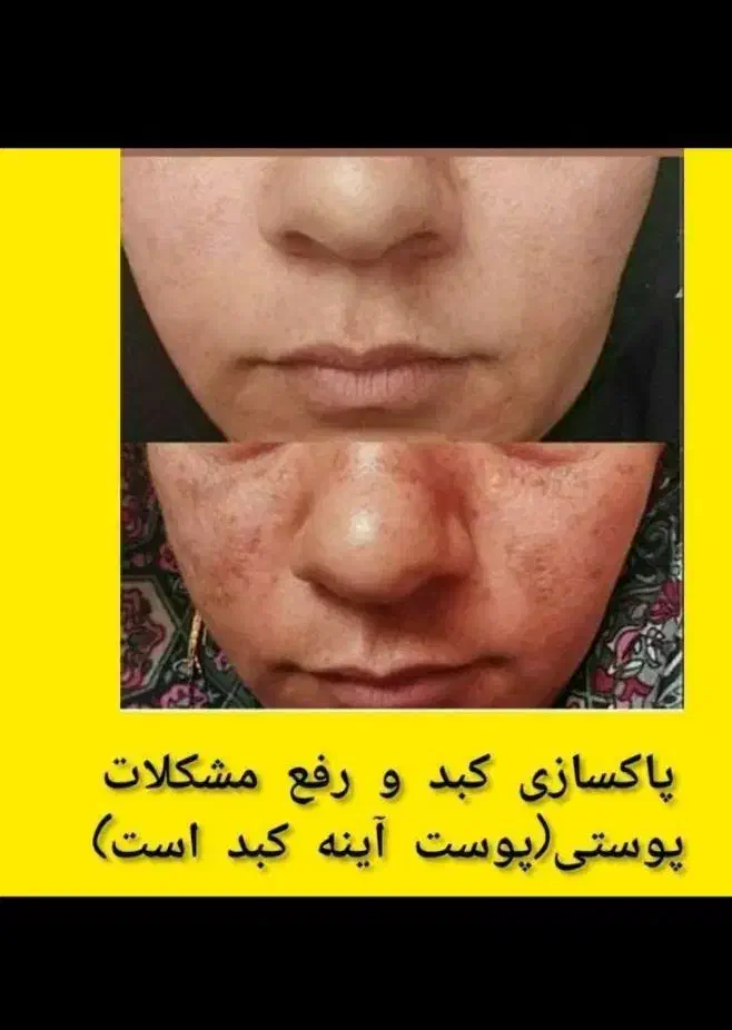 درمان و پاکسازی کبد|آرایشی، بهداشتی، درمانی|گنبد کاووس, |دیوار