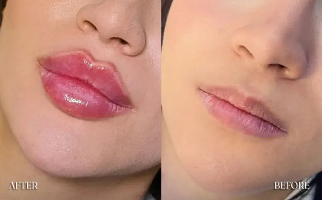 تخفیف 50 درصدی تزریق ژل و بوتاکس|خدمات آرایشگری و زیبایی|ارومیه, |دیوار