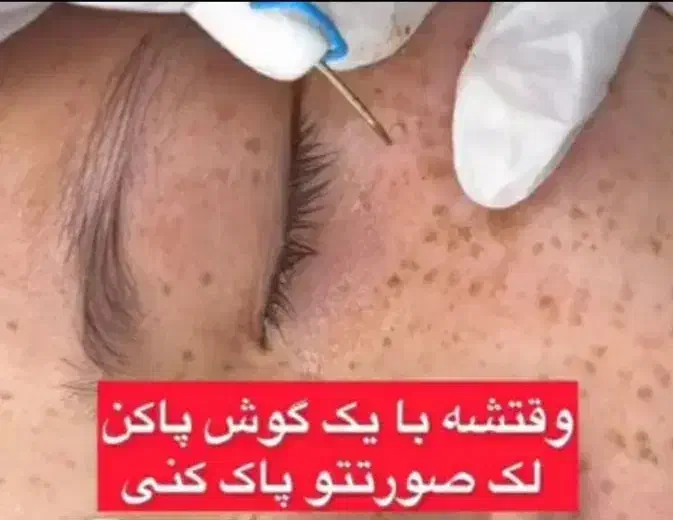 درمان تضمینی لک و کک و مک و خال /فقط در 1 جلسه|خدمات آرایشگری و زیبایی|اصفهان, لاله|دیوار