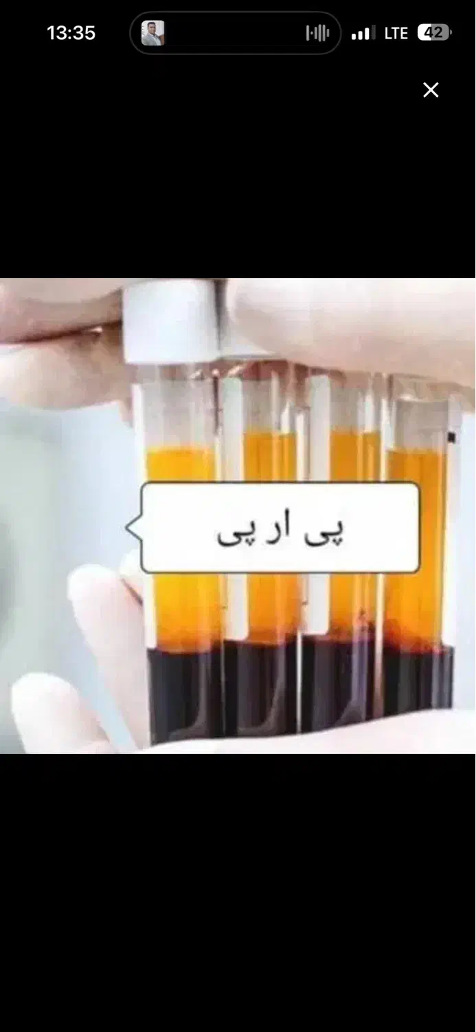 جشنواره تخفیف پی ار پی و بوتاکس|خدمات آرایشگری و زیبایی|کوهدشت, |دیوار