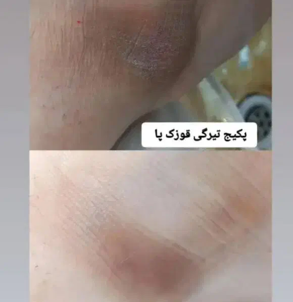 پدیکوروکف سابی پا. پاکسازی دست وپا قوزک ارنج وزانو|خدمات آرایشگری و زیبایی|جیرفت, |دیوار