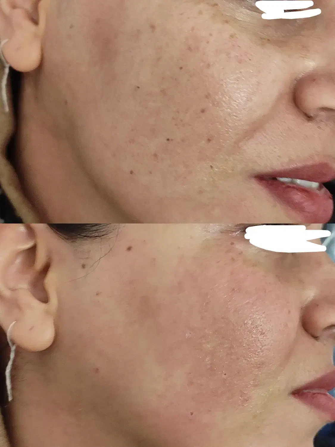 رفع کک و مک و لک . خال . اسکین تگ در یک جلسه|خدمات آرایشگری و زیبایی|بیرجند, |دیوار