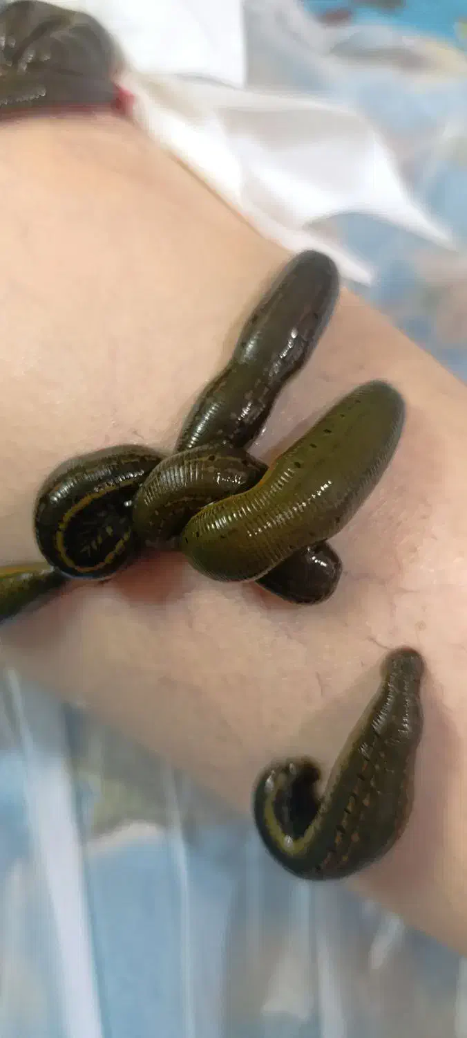 زالودرمانی / حجامت/ بادکش درمانگرآقاوخانم باسابقه|خدمات آرایشگری و زیبایی|مشهد, امام رضا (ع)|دیوار