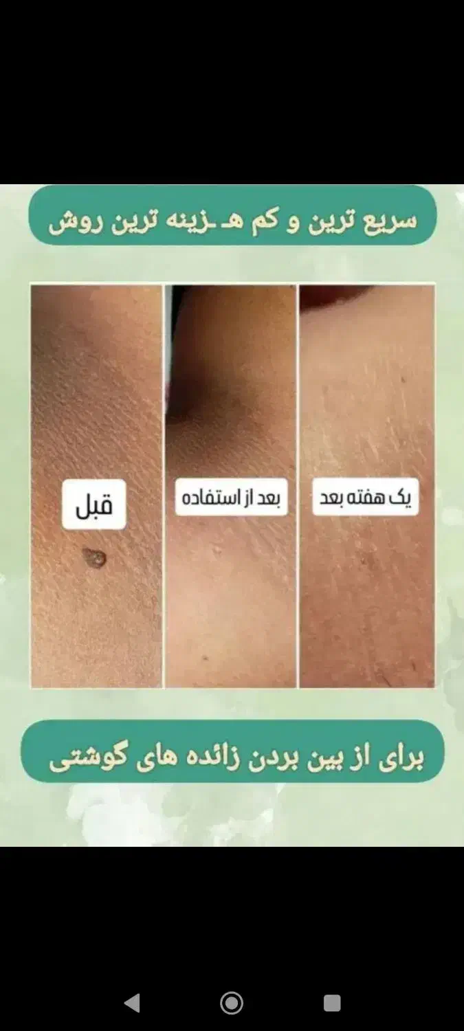 درمان خانگی زگیل و تبخال تناسلی|آرایشی، بهداشتی، درمانی|اصفهان, شهرک زاینده رود|دیوار