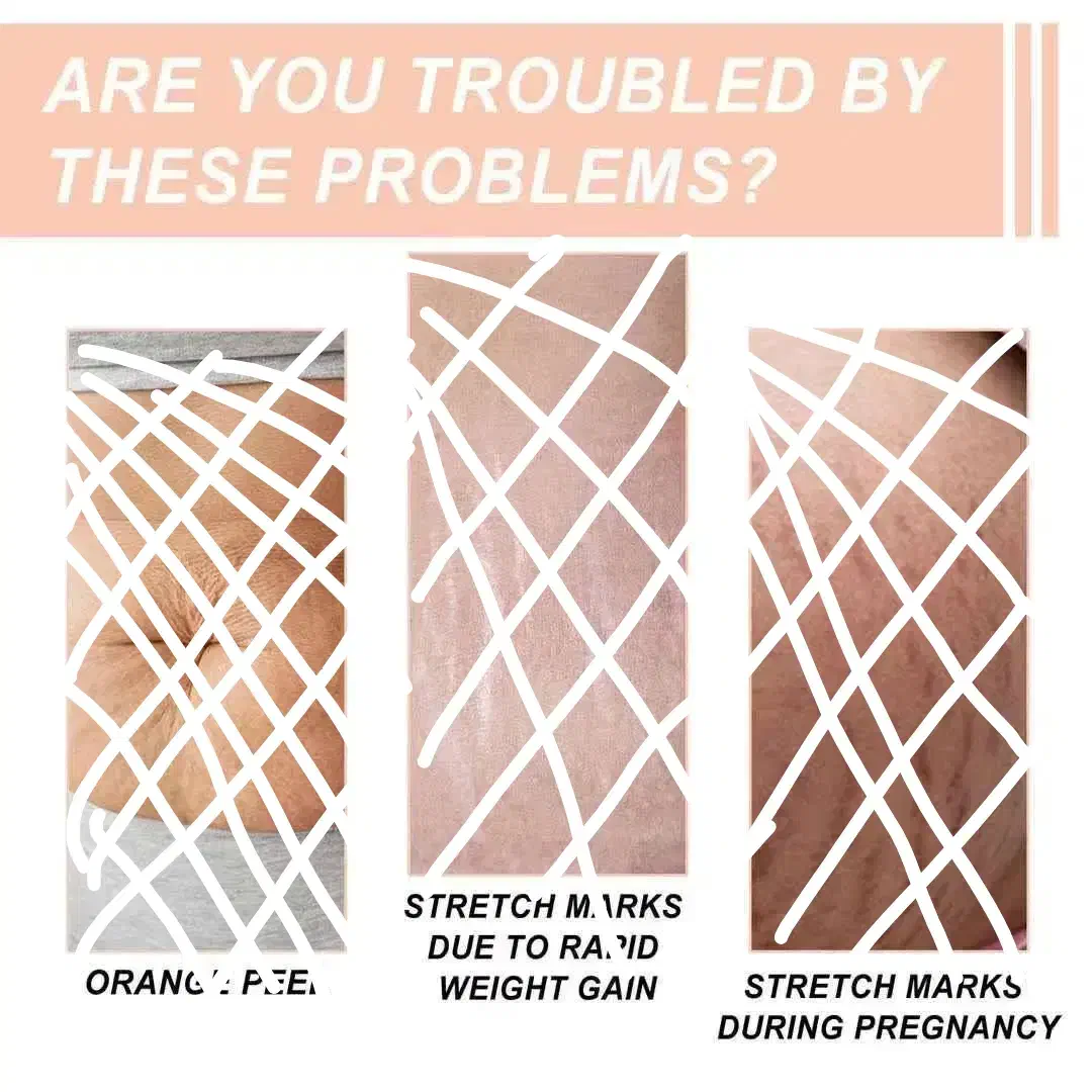 کرم ضد ترک شکم|آرایشی، بهداشتی، درمانی|برخوار, |دیوار