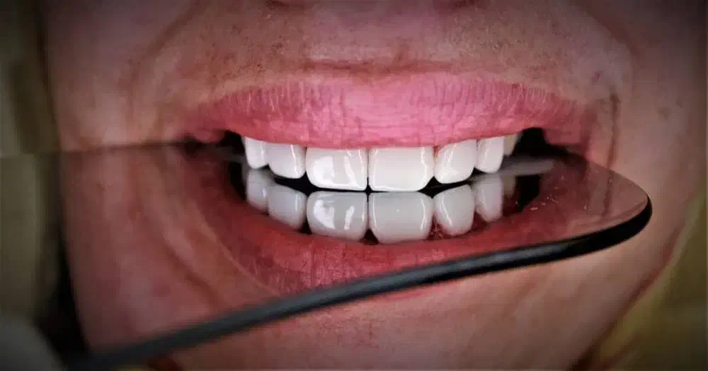 کامپوزیت دیجیتال و لمینیت با شرایط استثنایی در لار|خدمات آرایشگری و زیبایی|لار, |دیوار