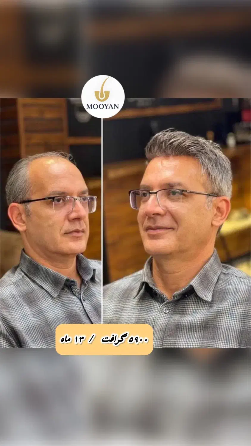 کاشت مو فقط با پرداخت ۱۰ میلیون|خدمات آرایشگری و زیبایی|تهران, جردن|دیوار