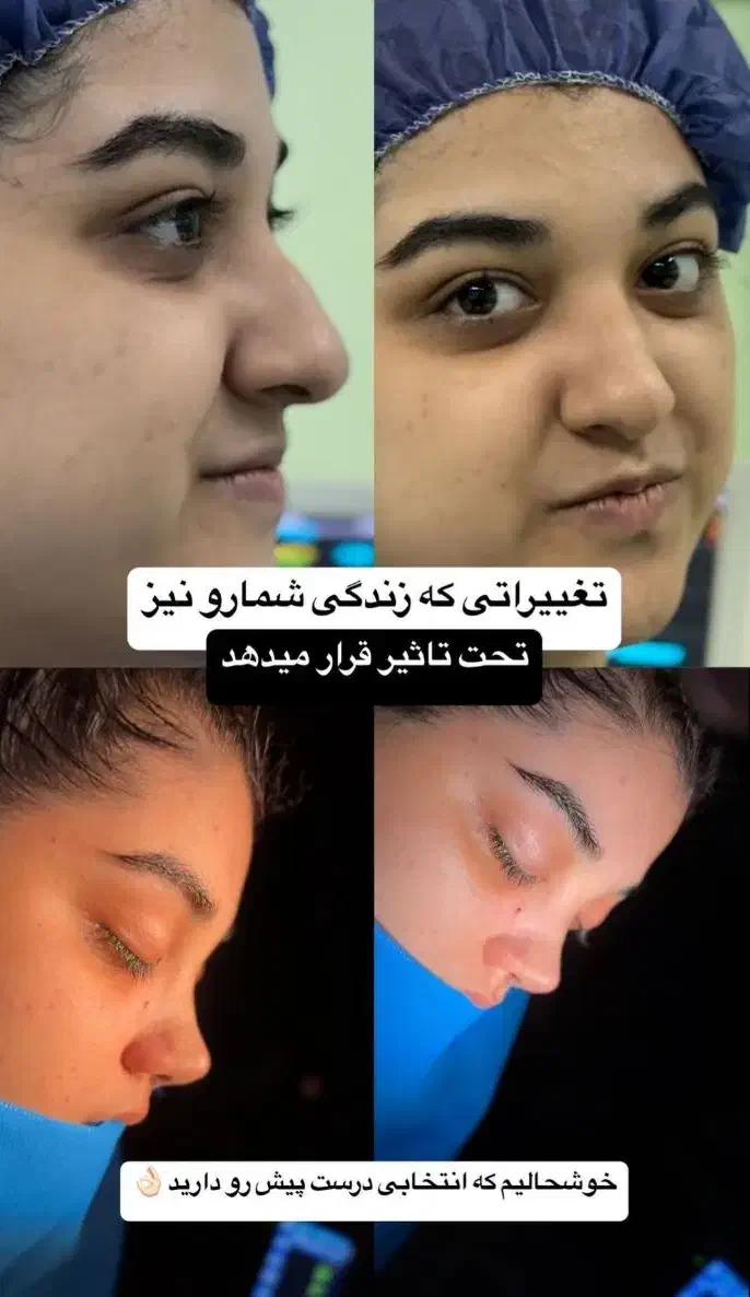آف زیبایی لیپو ابدو عمل بینی ۱۹ میلیون|خدمات آرایشگری و زیبایی|خرمشهر, |دیوار