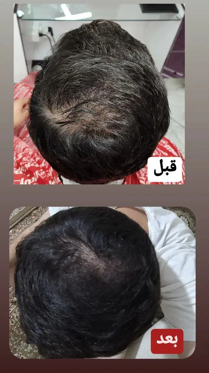 قطع ریزش مو و پرپشتی مو فقط با تکنیک اکسونیک|آرایشی، بهداشتی، درمانی|بوشهر, |دیوار