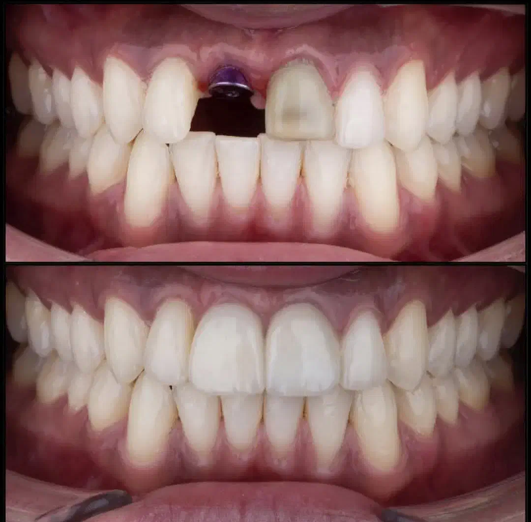 دندانپزشکی ایمپلنت تخصصی از ۵ میلیون اقساطی وام|خدمات آرایشگری و زیبایی|تبریز, |دیوار