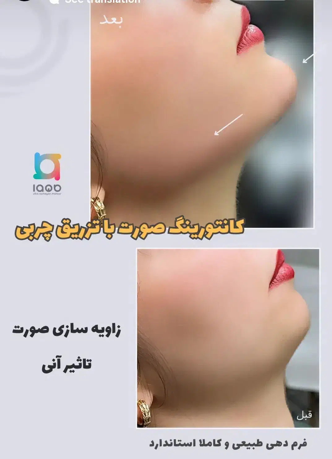 کاشت مو و ابرو / بوتاکس / چربی ژل /کلینیک /زیبایی|خدمات آرایشگری و زیبایی|بوکان, |دیوار