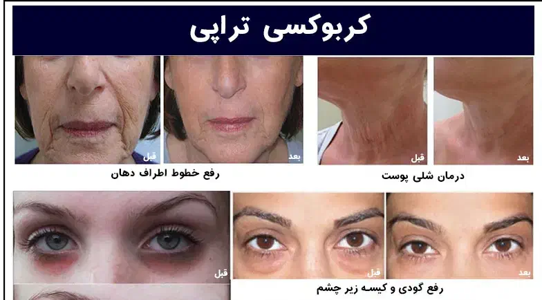 کربوکسی تراپی|خدمات آرایشگری و زیبایی|رفسنجان, |دیوار