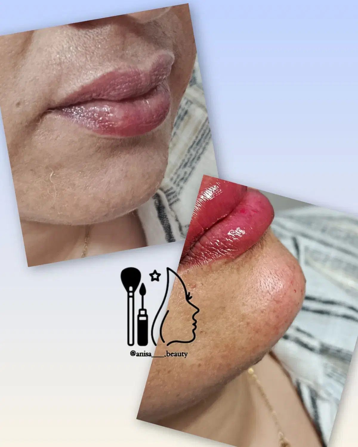 تزریق ژل و بوتاکس|خدمات آرایشگری و زیبایی|جهرم, |دیوار