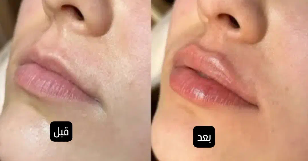 بوتاکس جوانساز آنزیم فیلر|خدمات آرایشگری و زیبایی|ملایر, |دیوار