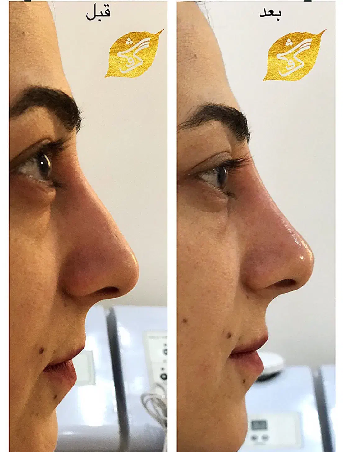 تزریق آنزیم و فیلر بینی|خدمات آرایشگری و زیبایی|تهران, پاسداران|دیوار