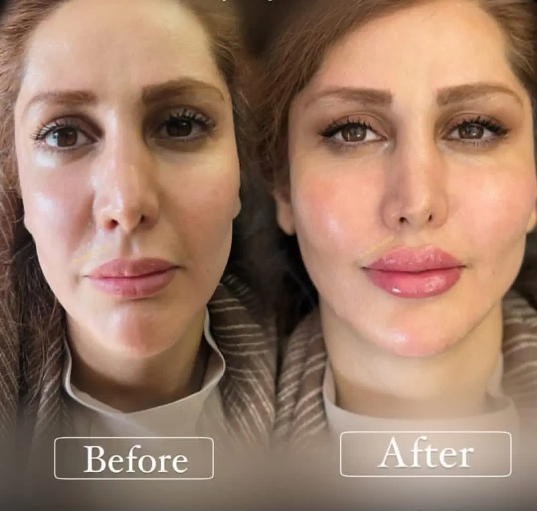 ژل وبوتاکس حرفه ای در کلینیک|خدمات زیبایی و سلامت|کرمانشاه, |دیوار