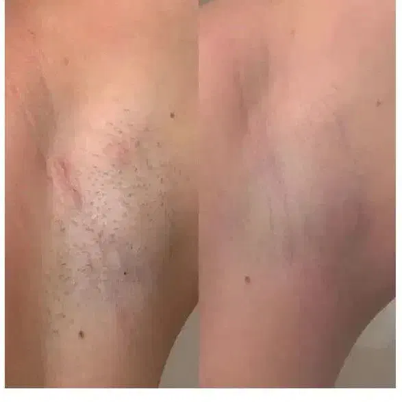 تخفیف لیزرکل بدن فقط۴۵۰ بمناسبت روزمادر تست رایگان|خدمات آرایشگری و زیبایی|زنجان, |دیوار