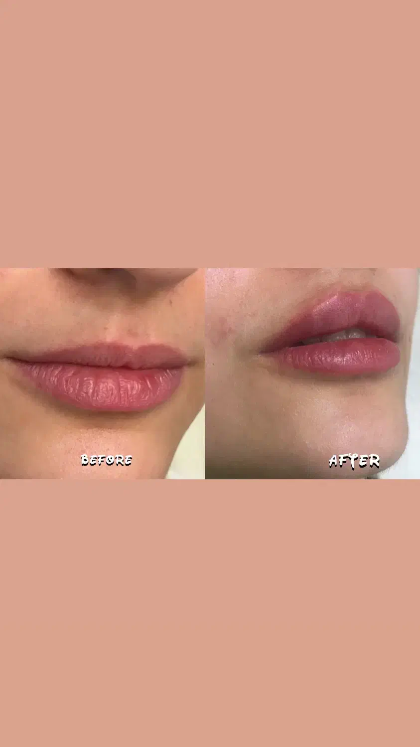 نیاز به مدل برای تزریق فیلر فول فیس(لب،زاویه،چونه)|خدمات آرایشگری و زیبایی|آستانه اشرفیه, |دیوار