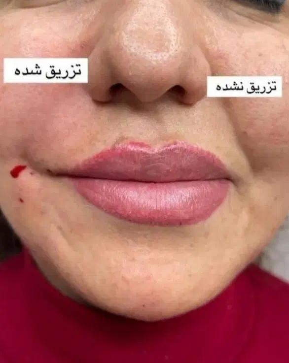 جشنواره زیبایی((مدل ژل وبوتاکس))|خدمات آرایشگری و زیبایی|سنندج, |دیوار