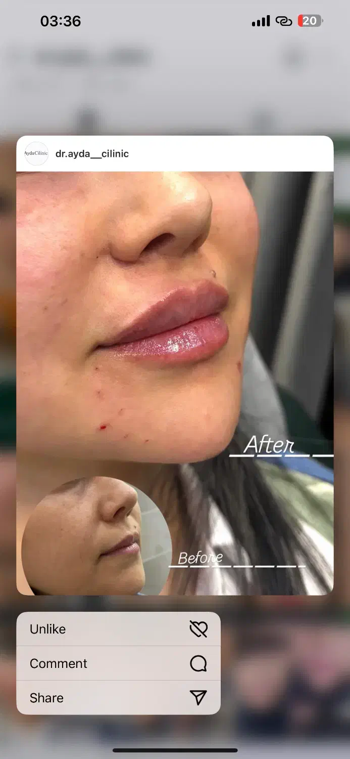 تخفیف بوتاکس و ژل|خدمات آرایشگری و زیبایی|دهگلان, |دیوار