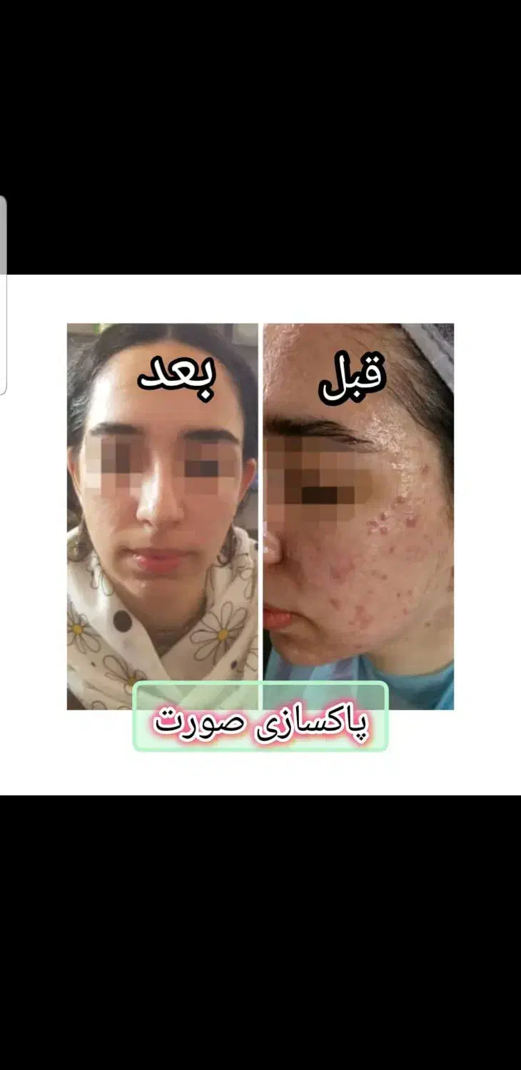 ژل بوتاکس ساکشن چربی نخ لیزر PRPجراحی زیبایی سهند|خدمات آرایشگری و زیبایی|سهند, |دیوار