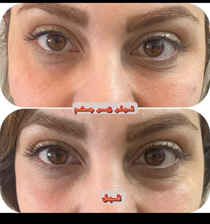 تزریق آموزش ژل بوتاکس چربی|خدمات آرایشگری و زیبایی|صدرا-فارس, فاز ۱|دیوار