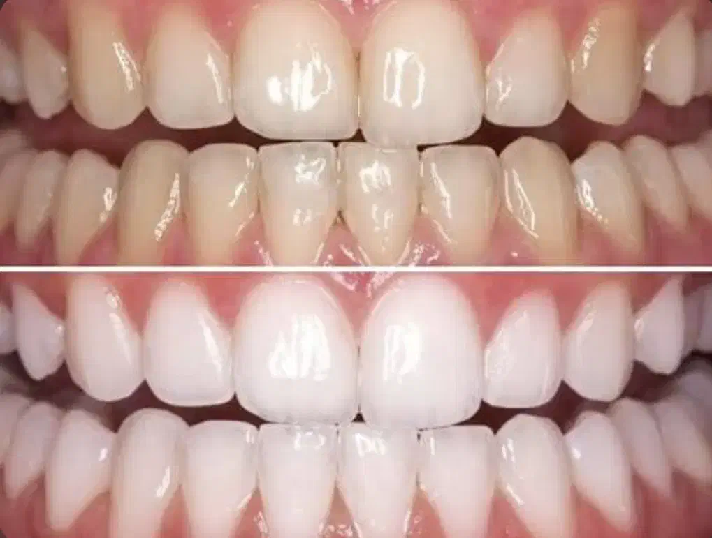 پودر سفید کننده دندان|آرایشی، بهداشتی، درمانی|اهواز, آریاشهر|دیوار