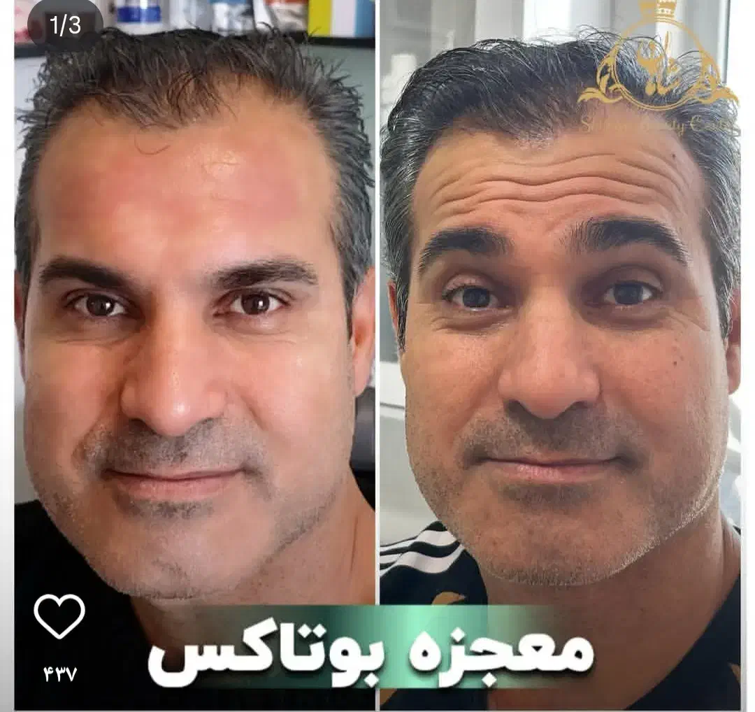 خدمات تخصصی تزریق بوتاکس فیلر بانوان و آقایون|خدمات آرایشگری و زیبایی|بیرجند, |دیوار