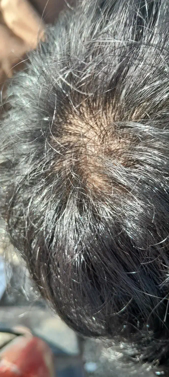 ریزش مو دارم پسر 18ساله هستم|فعالیت داوطلبانه|مشهد, هفده شهریور|دیوار