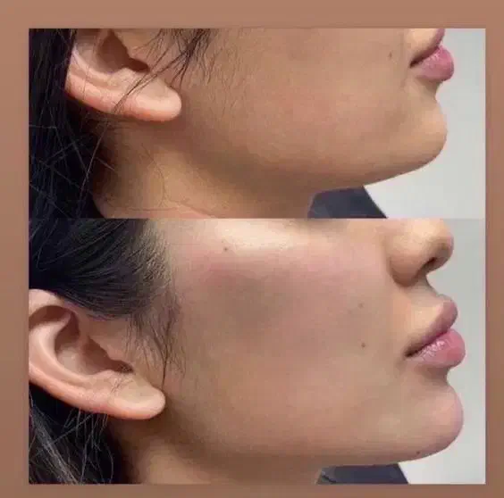 جشنواره تخفیفی تزریقات،کربن، ژل و بوتاکس،لیزر|خدمات آرایشگری و زیبایی|بندرعباس, |دیوار