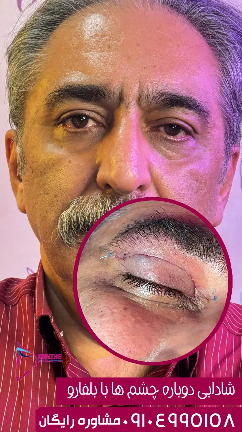 بلفاروپلاستی توسط متخصص چشم با بخیه سوپرنانو لیزری|خدمات آرایشگری و زیبایی|تهران, جردن|دیوار