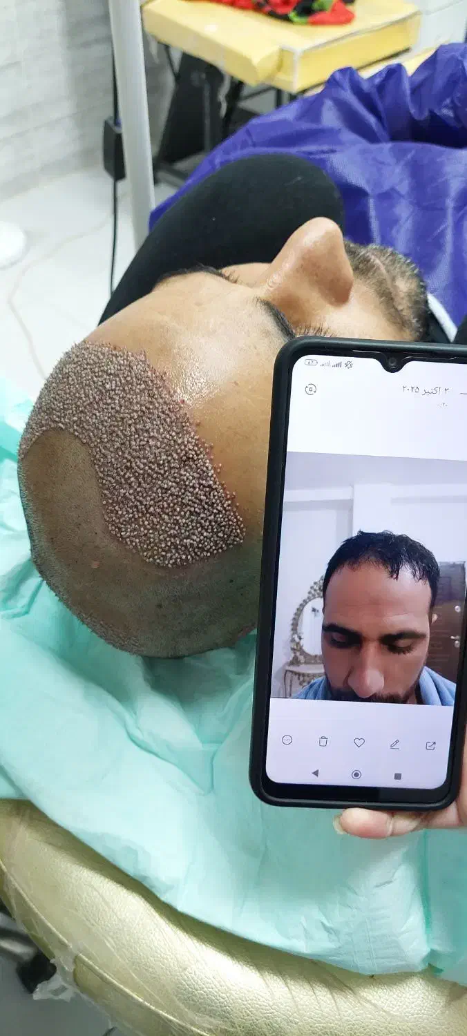 تخفیف ویژه کاشت مو و ابرو|خدمات آرایشگری و زیبایی|کرمانشاه, |دیوار