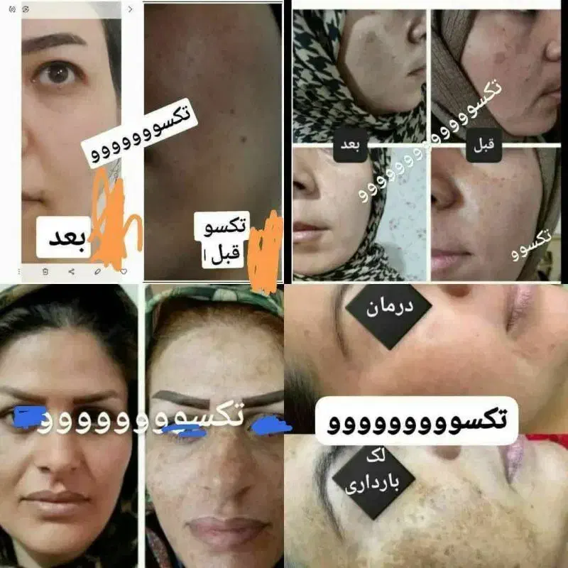 ازبین بردن لک صورت|آرایشی، بهداشتی، درمانی|اردل, |دیوار