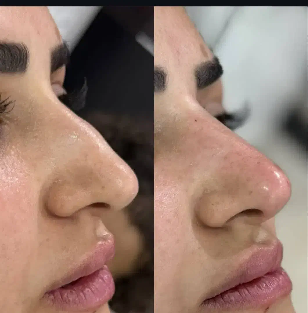 کانتورینگ لیفت فیلر بوتاکس مزو|خدمات آرایشگری و زیبایی|اصفهان, سپاهان‌شهر|دیوار