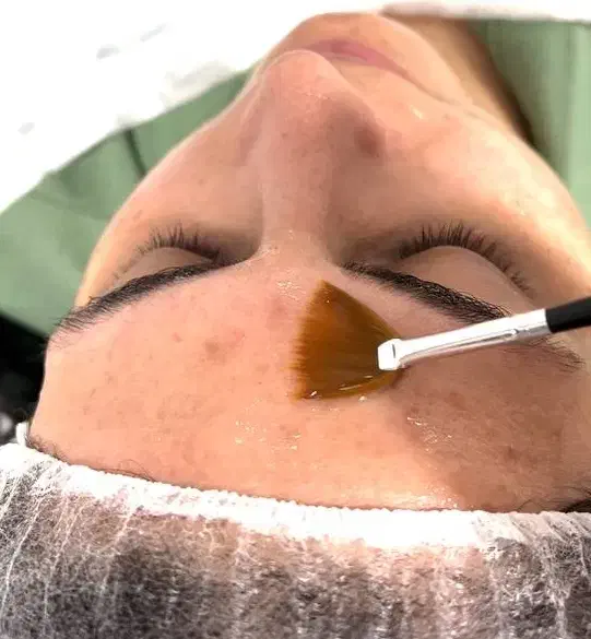 مدل برای اسیدتراپی|خدمات آرایشگری و زیبایی|رشت, پورسینا|دیوار