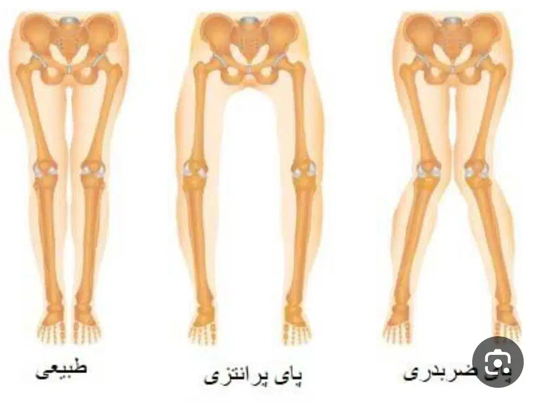 مرکز تخصصی اصلاح غیرجراحی انحرافات زانو|خدمات آرایشگری و زیبایی|بهار, |دیوار