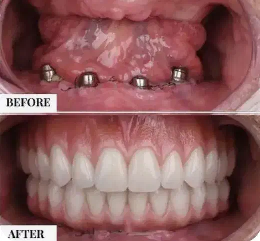 جشنواره پاییزه کامپوزیت،لمینیت،ایمپلنت اقساط|خدمات آرایشگری و زیبایی|بومهن, |دیوار