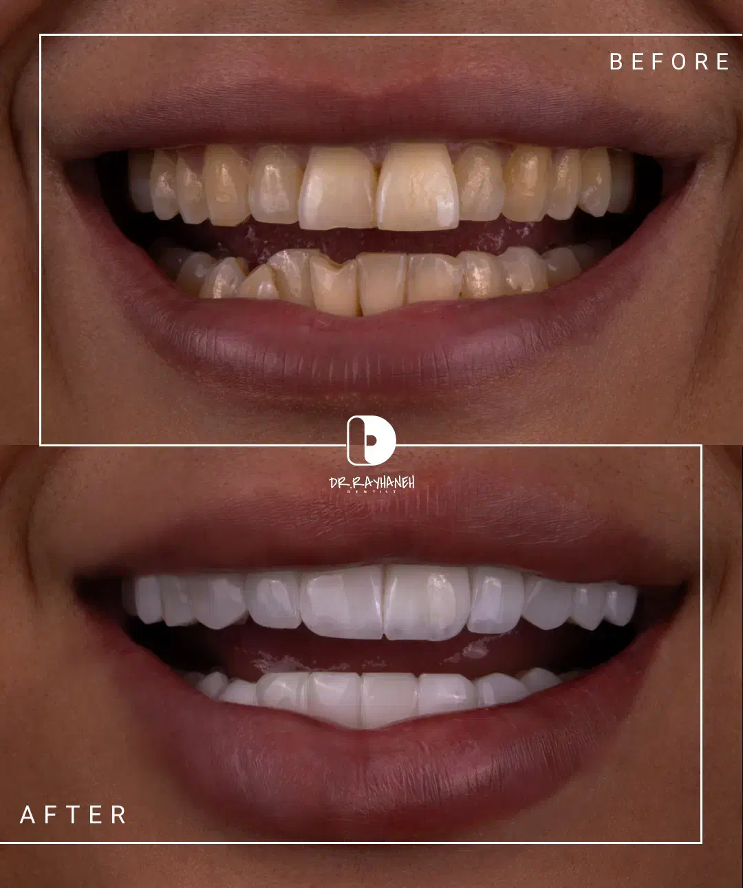 کامپوزیت/لمینت/دندانپزشکی|خدمات آرایشگری و زیبایی|مشهد, کوثر|دیوار