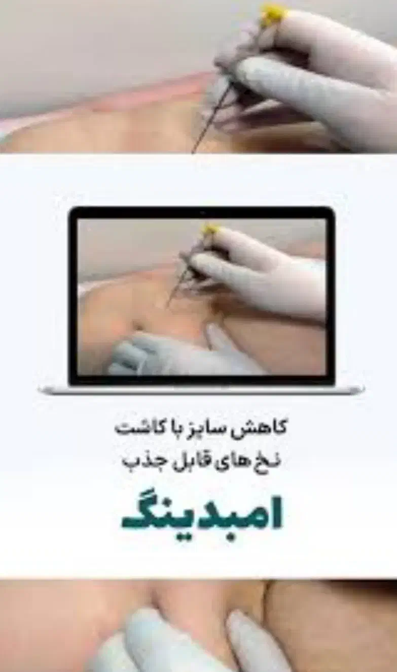 کاشت نخ چربی سوز امبدینگ ،ژل وبوتاکس|خدمات آرایشگری و زیبایی|قم, نیروگاه|دیوار