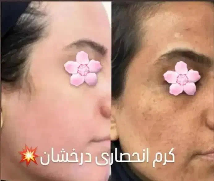 کرم انحصاری درخشان بدون بازگشت|آرایشی، بهداشتی، درمانی|رشت, منظریه|دیوار