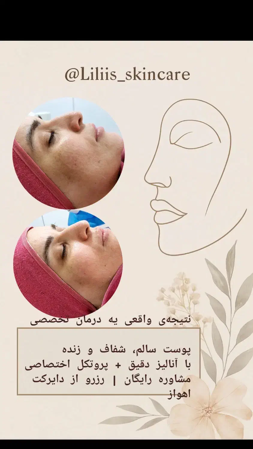 فیشیال و پاکسازی پوست|خدمات آرایشگری و زیبایی|اهواز, رسالت|دیوار