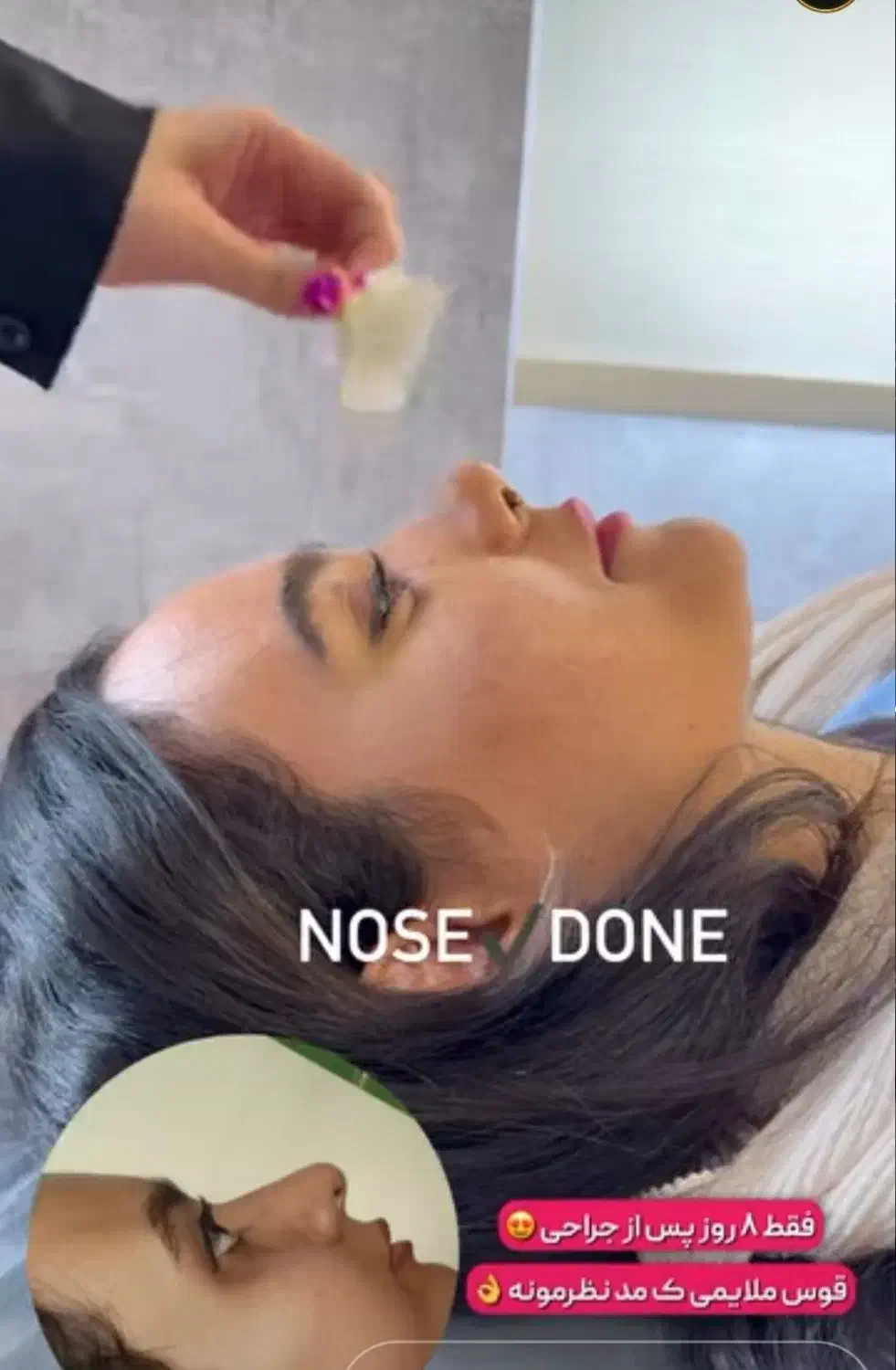 جراحی بینی فقط ۸و۹ آذر فقط۲۹ میلیون تومان|خدمات آرایشگری و زیبایی|فریدونشهر, |دیوار