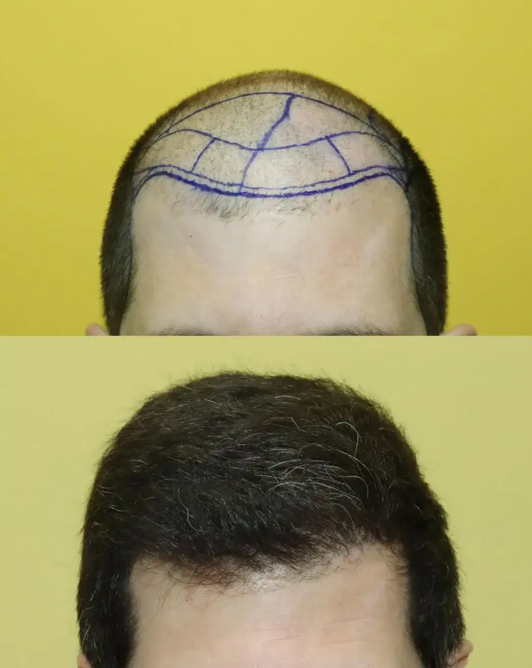 کاشت موی شیرازی|خدمات آرایشگری و زیبایی|مریوان, |دیوار